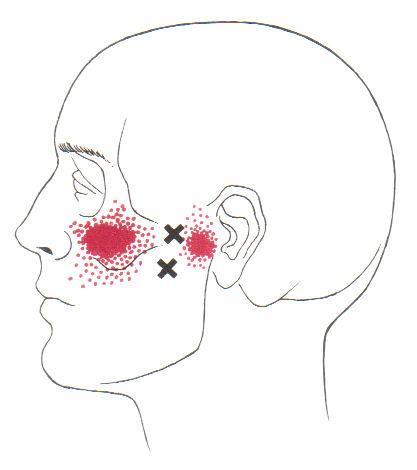 lateral pterygoid pain Travell and Simons